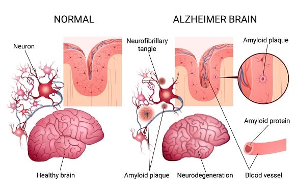 Tau tangles and amyloid plaques in Down syndrome related Alzheimer's disease