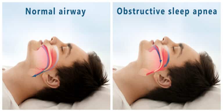 Sleep apnea Down syndrome